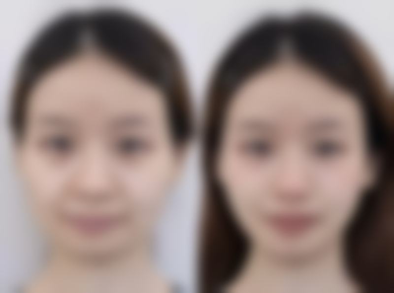 临床实例分享 - 深圳唯美星医疗美容门诊部涂林医生